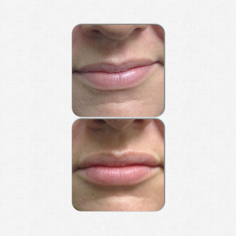 juvederm-lips