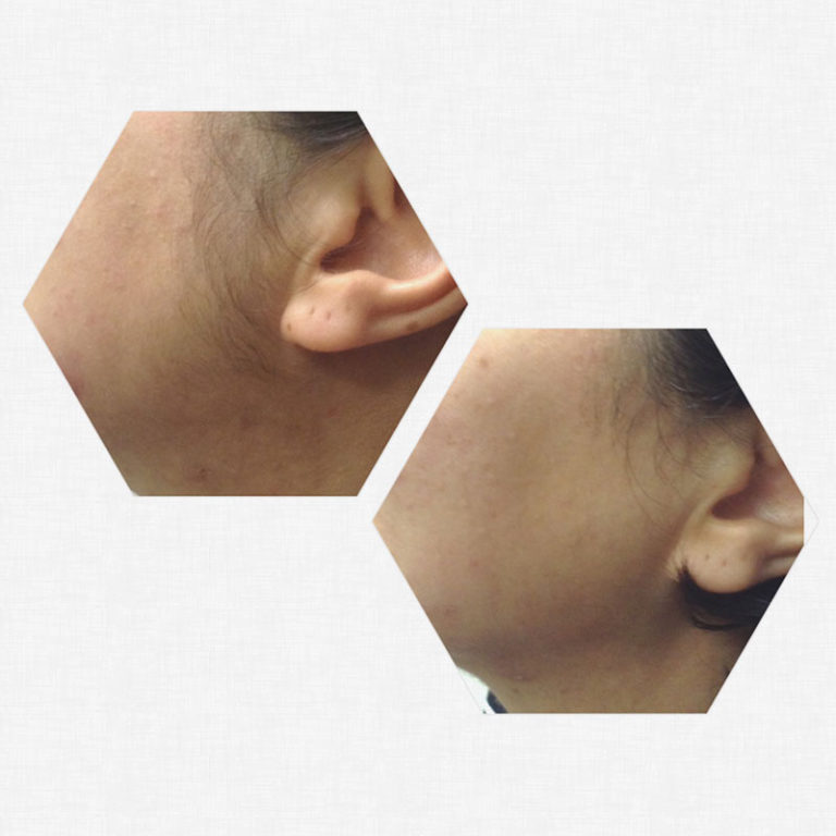 Laser Hair Removal Quad Cities Serenity Salon & Day Spa